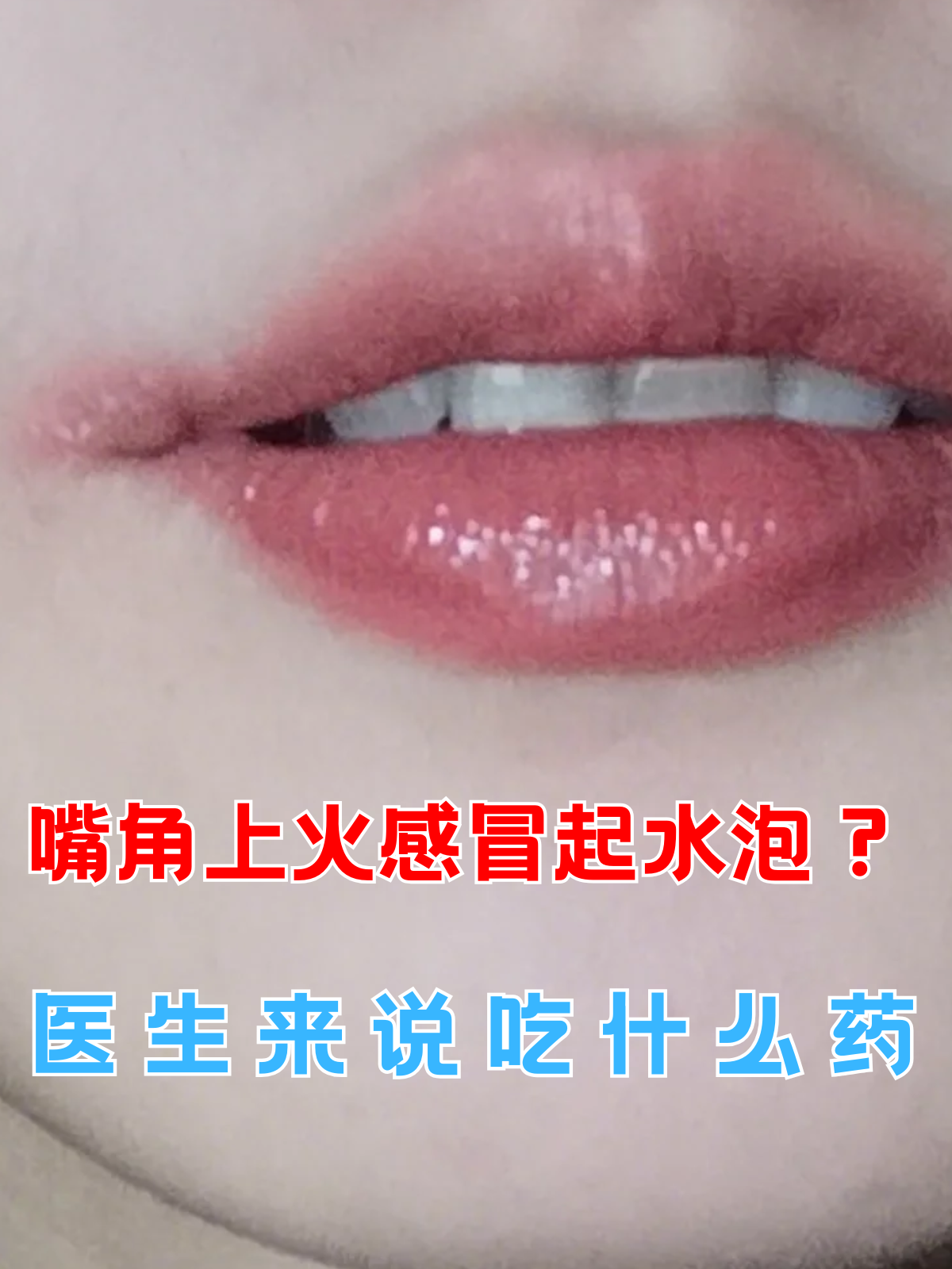 嘴角起泡有点痒怎么办