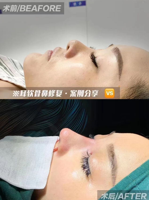 朝天鼻情况怎么矫正