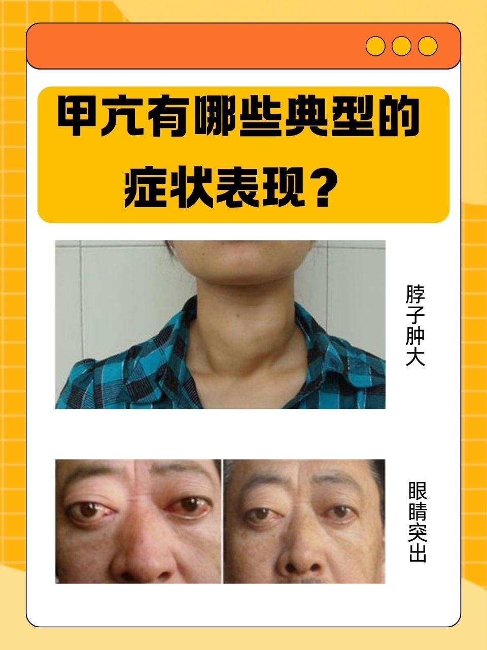 甲亢治疗方式的优缺点?