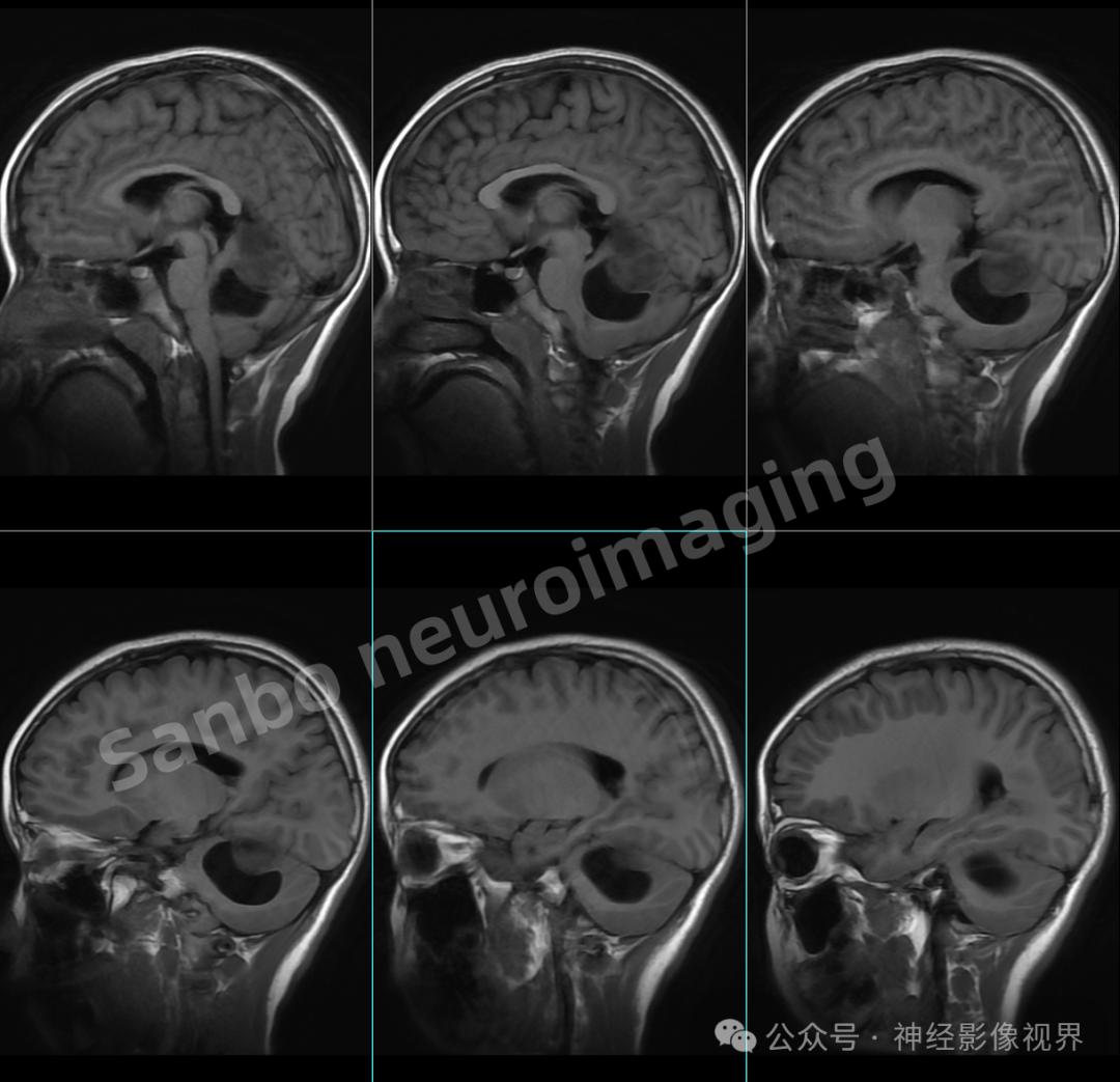 星形细胞瘤是什么