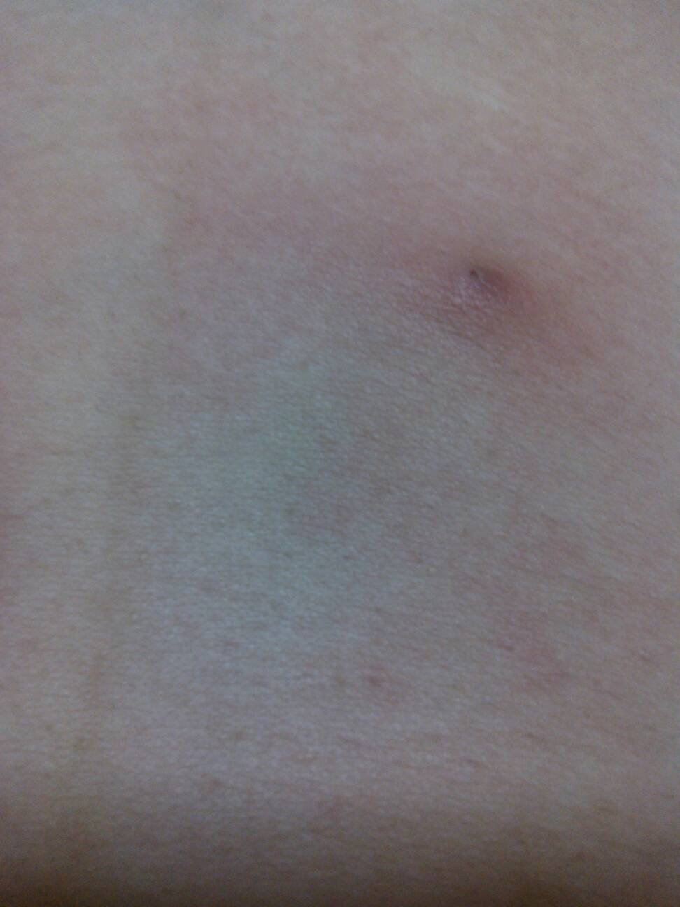 小腹表皮上长了一个大疙瘩