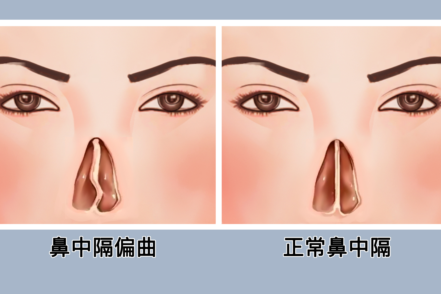 鼻中隔偏曲会癌变吗