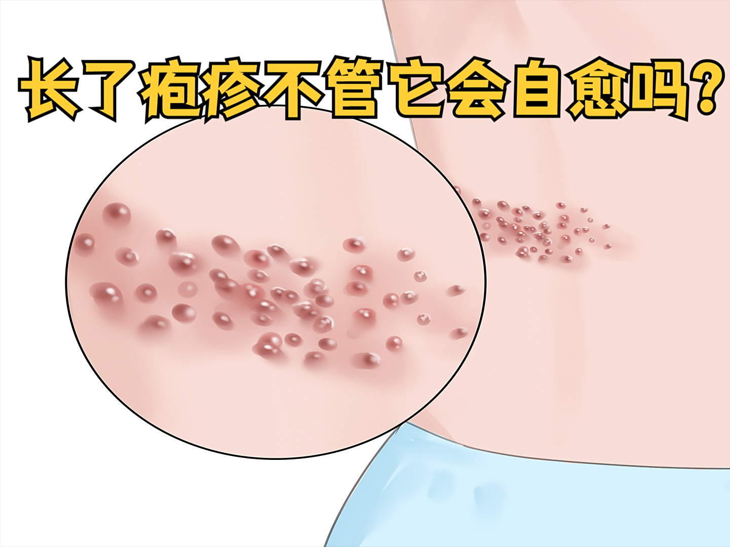 单纯疱疹会传染吗