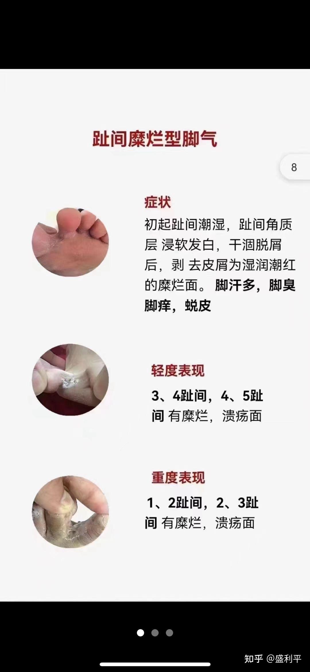 脚气与脚气病的区别