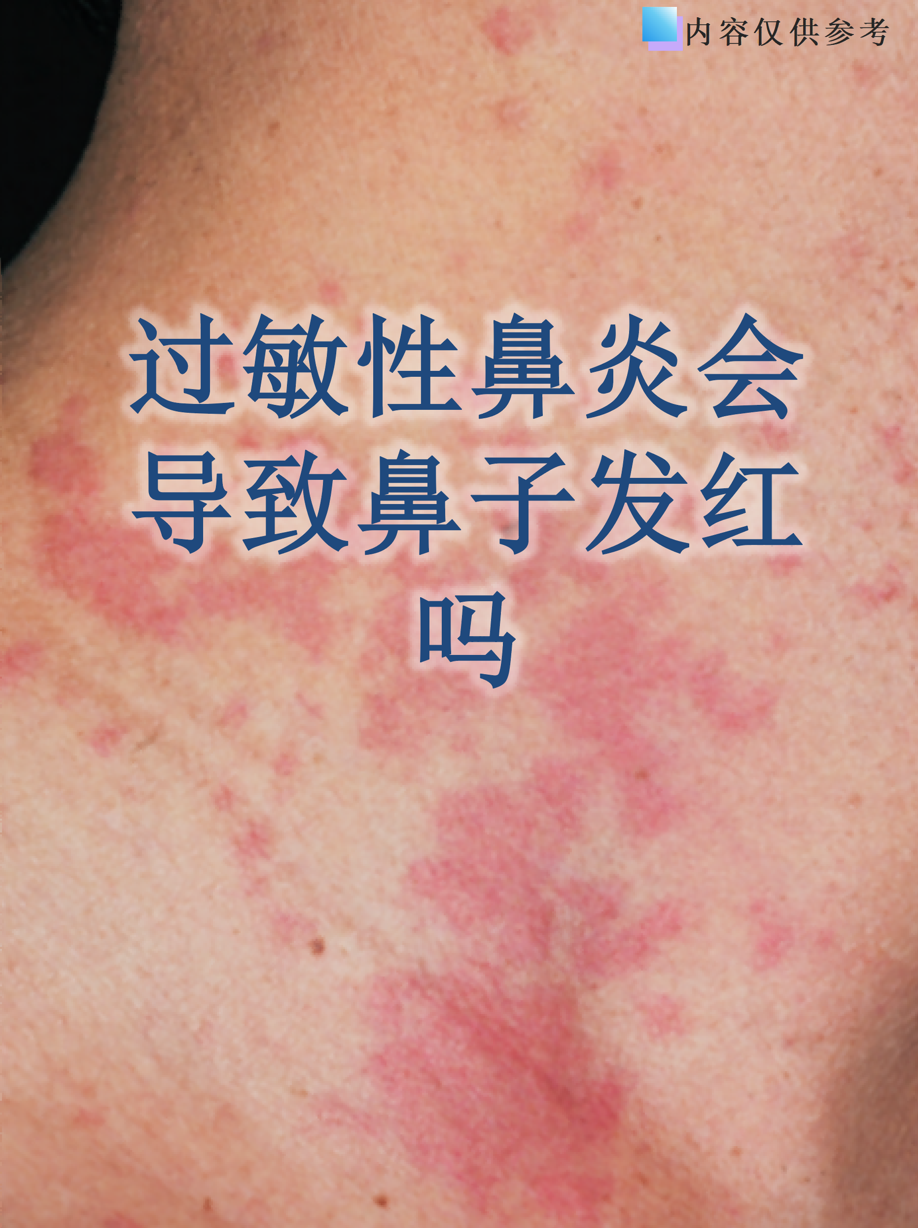 鼻子两边发红,是什么原因