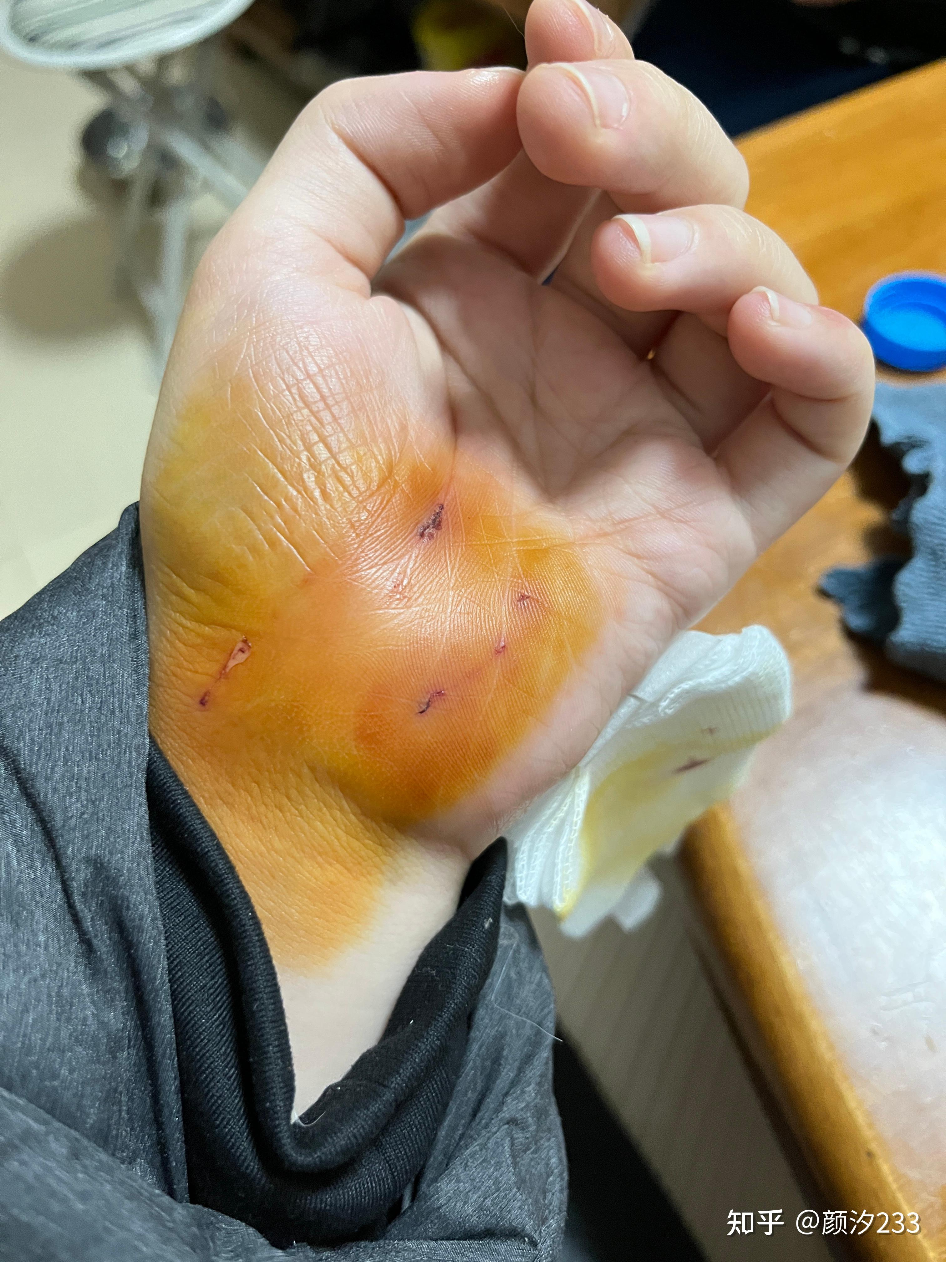 我被我家两个月多的小猫咬了一个比针眼大点小眼