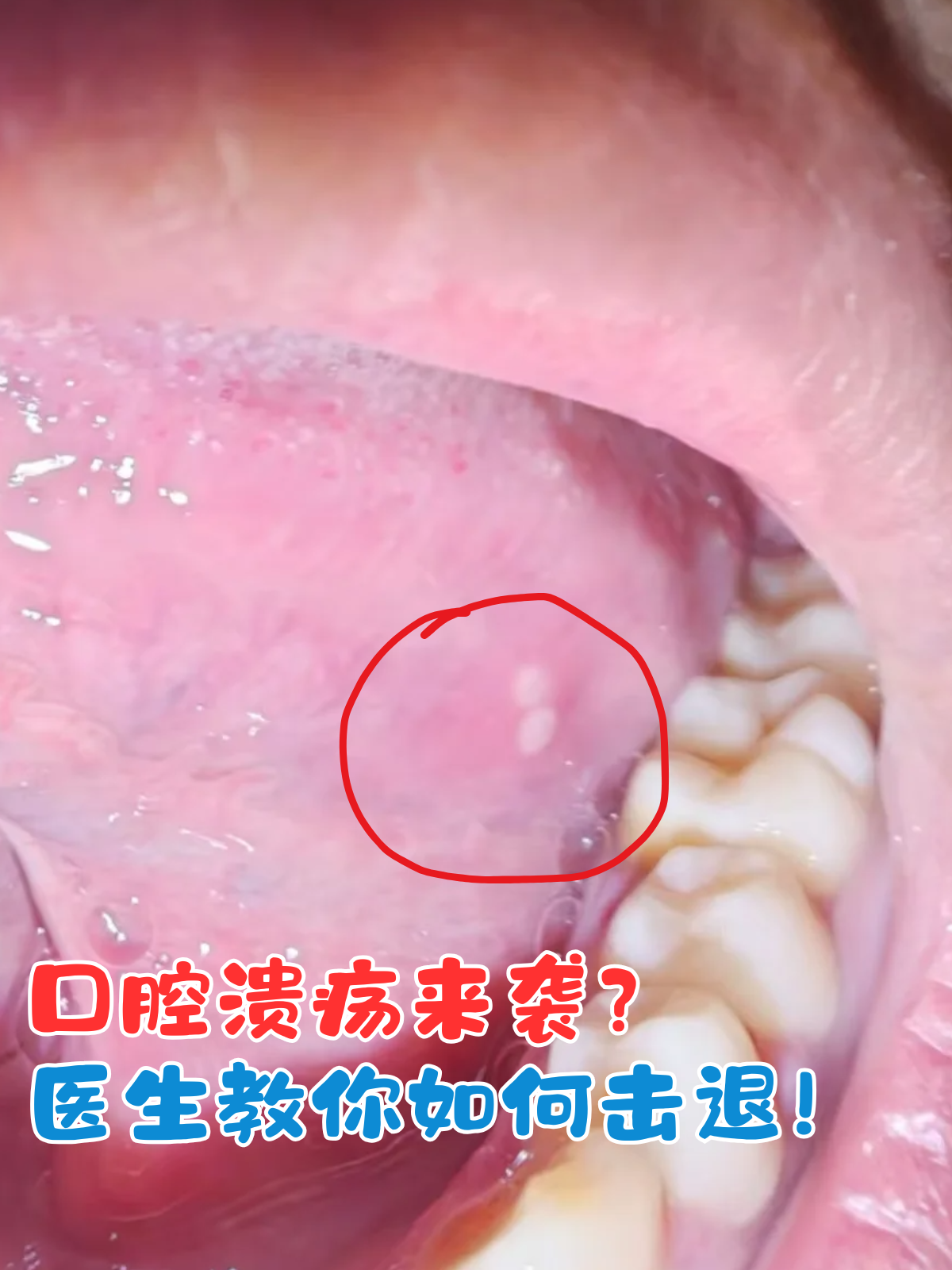 口舌生疮的原因