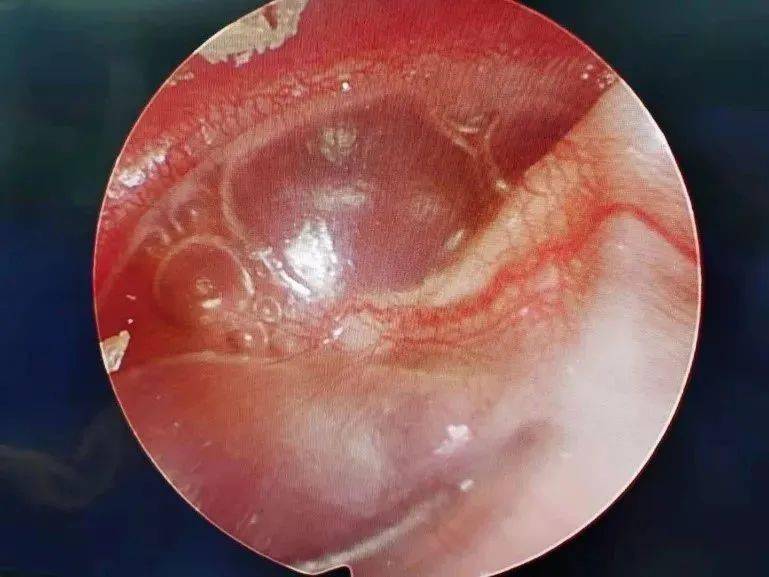 分泌性中耳炎会聋吗