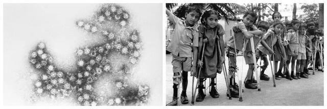 什么是脊髓灰质炎