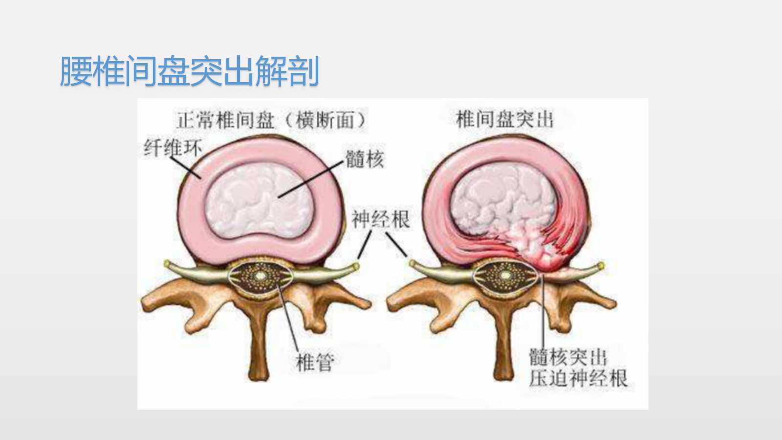 腰椎间盘突出的分型