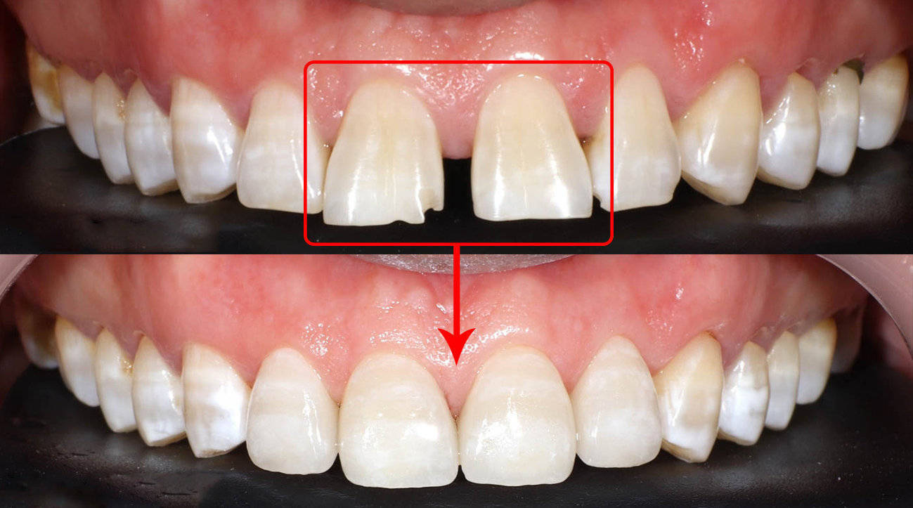 牙缝变大还能恢复吗