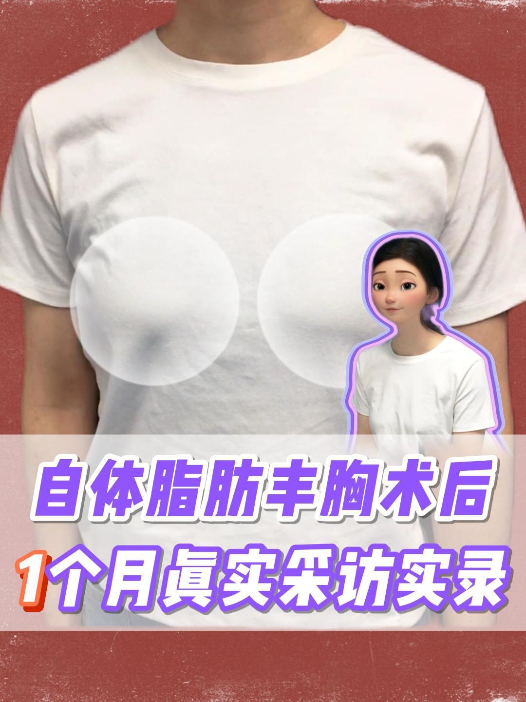什么是自体丰胸?