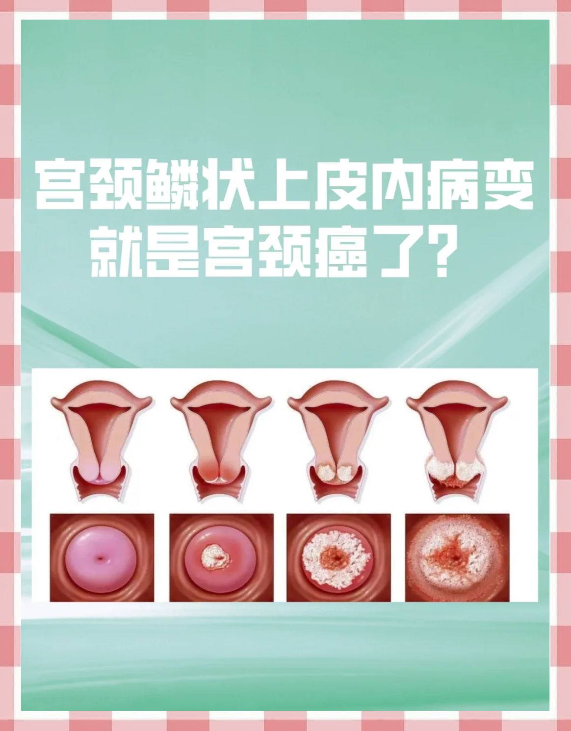 高度鳞状上皮内病变是什么病