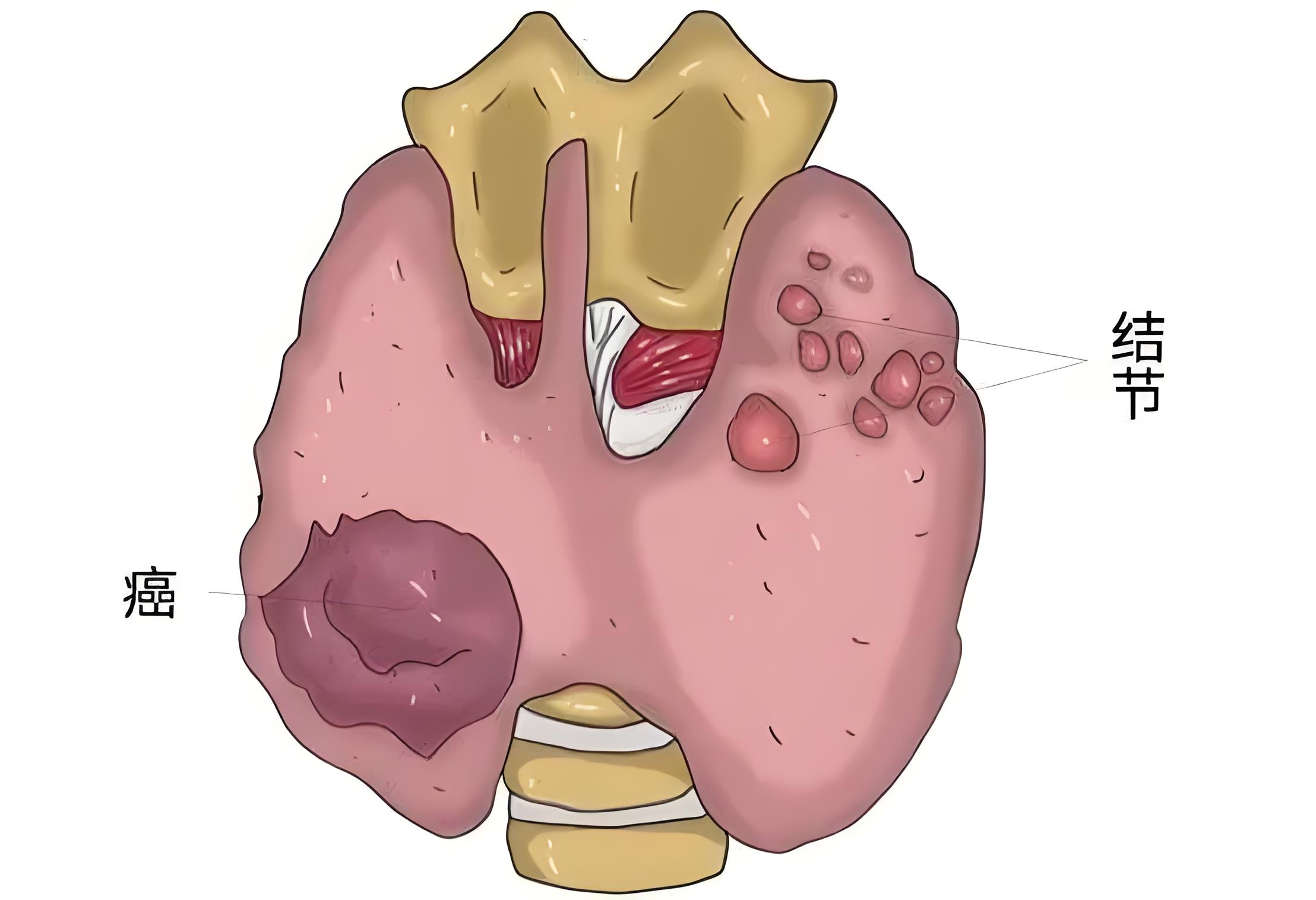 什么叫结节性甲状腺肿?