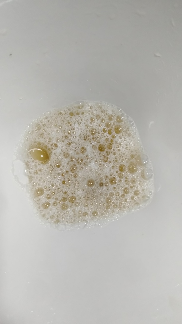 尿里面有油花,是怎么回事