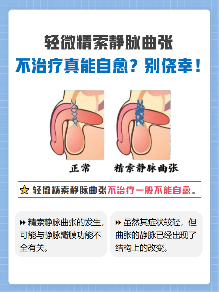 双侧精索静脉曲张严重吗