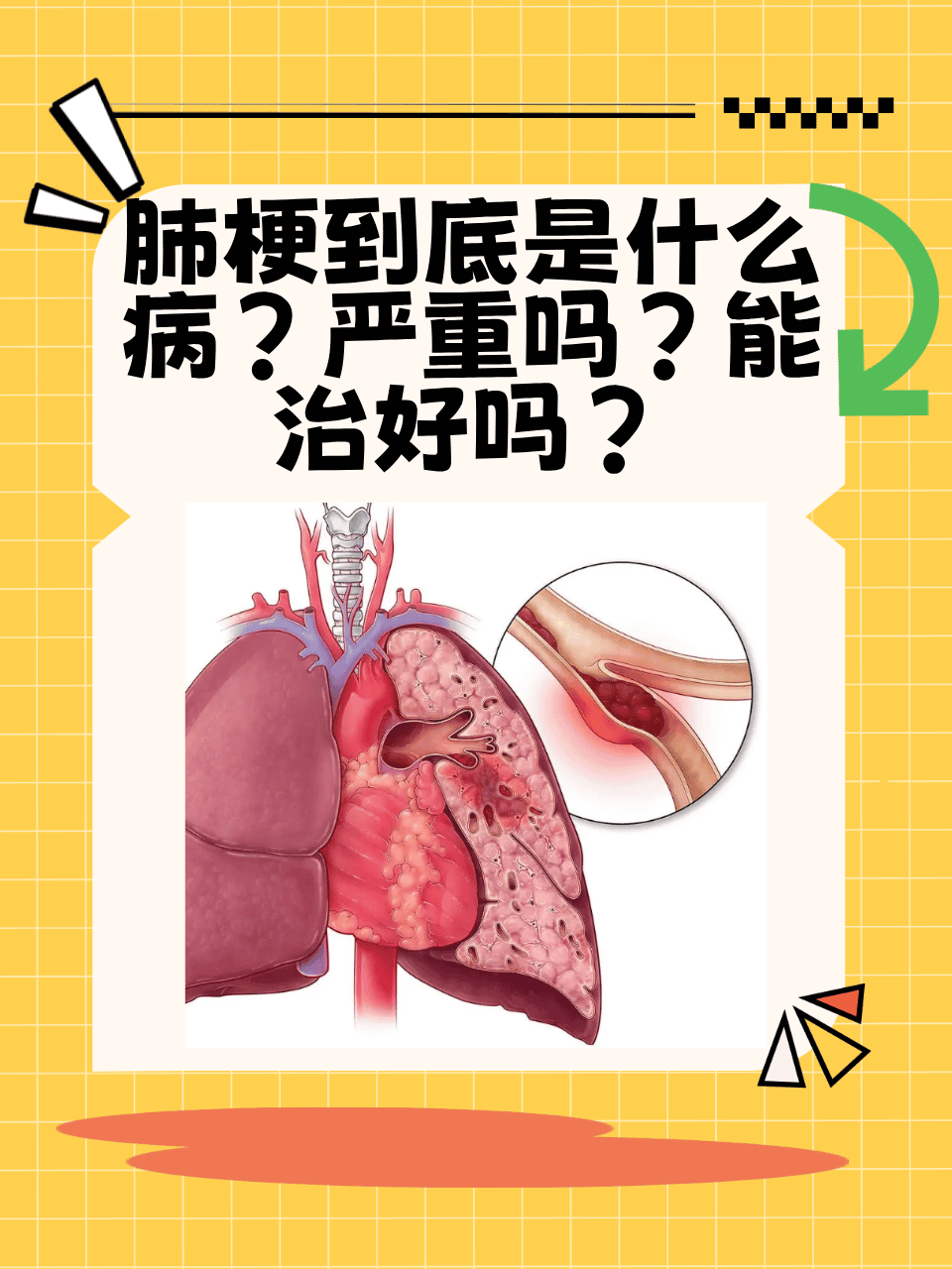 肺病有什么症状?