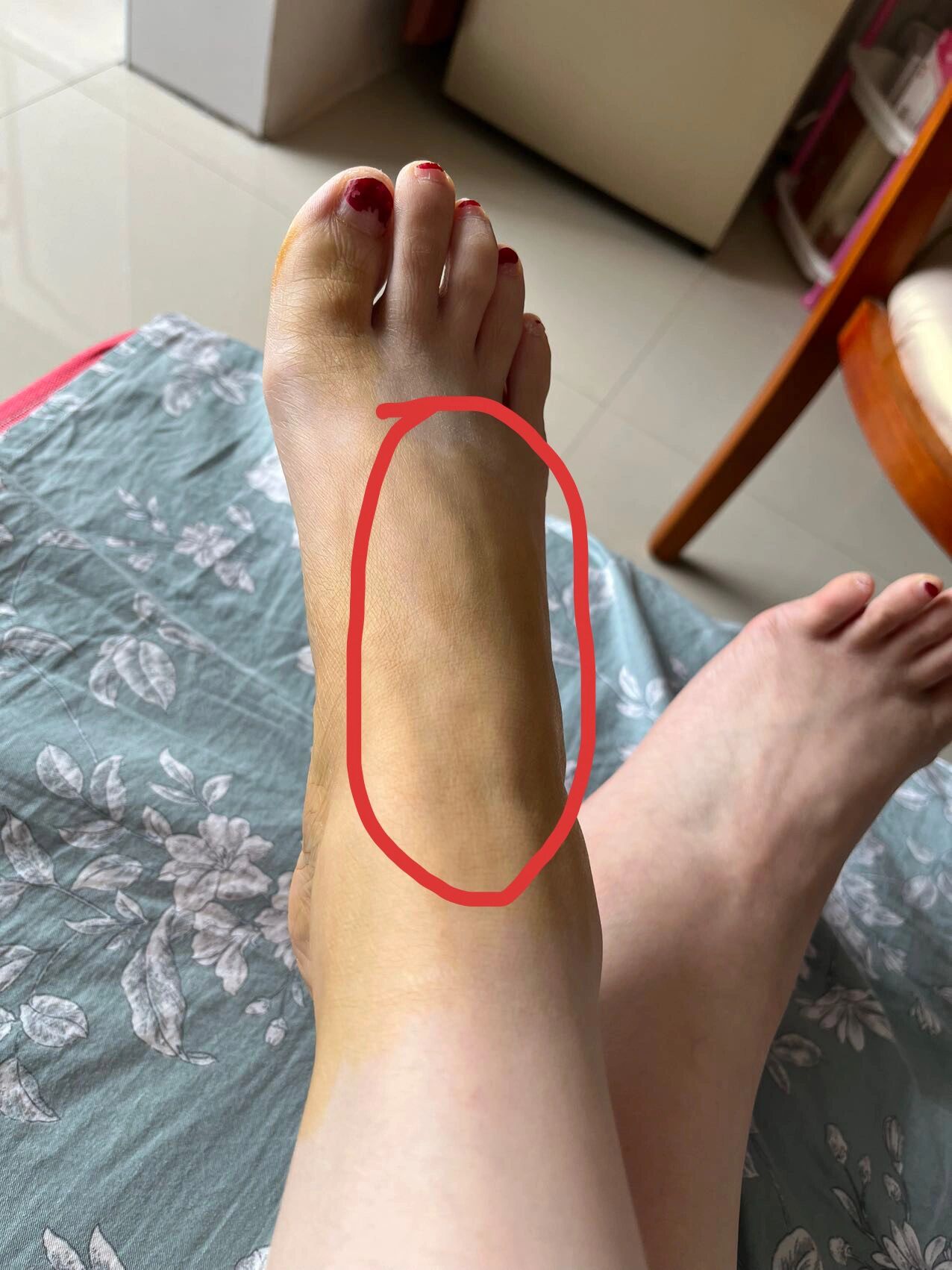 脚踝韧带损伤能自愈吗