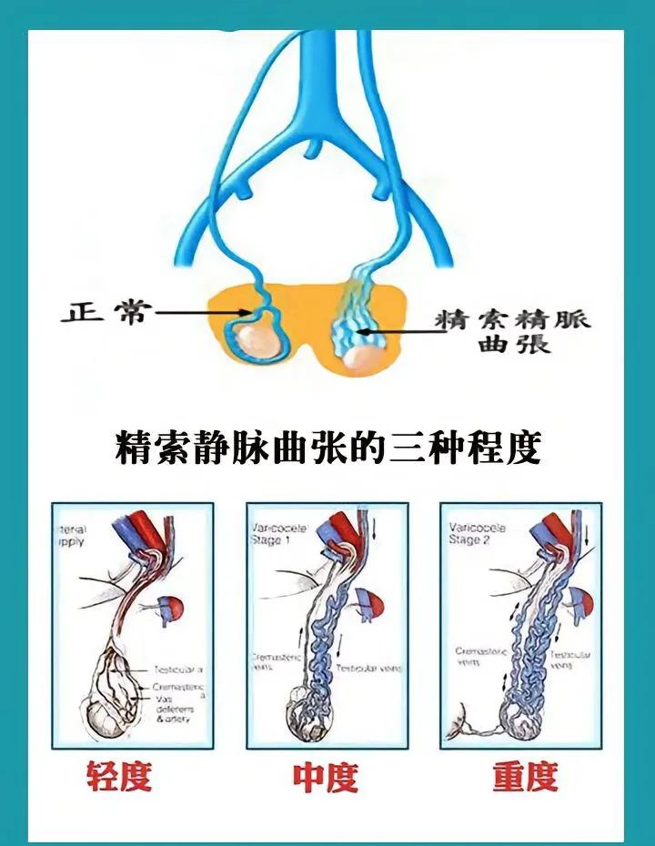 如何认识精索静脉曲张