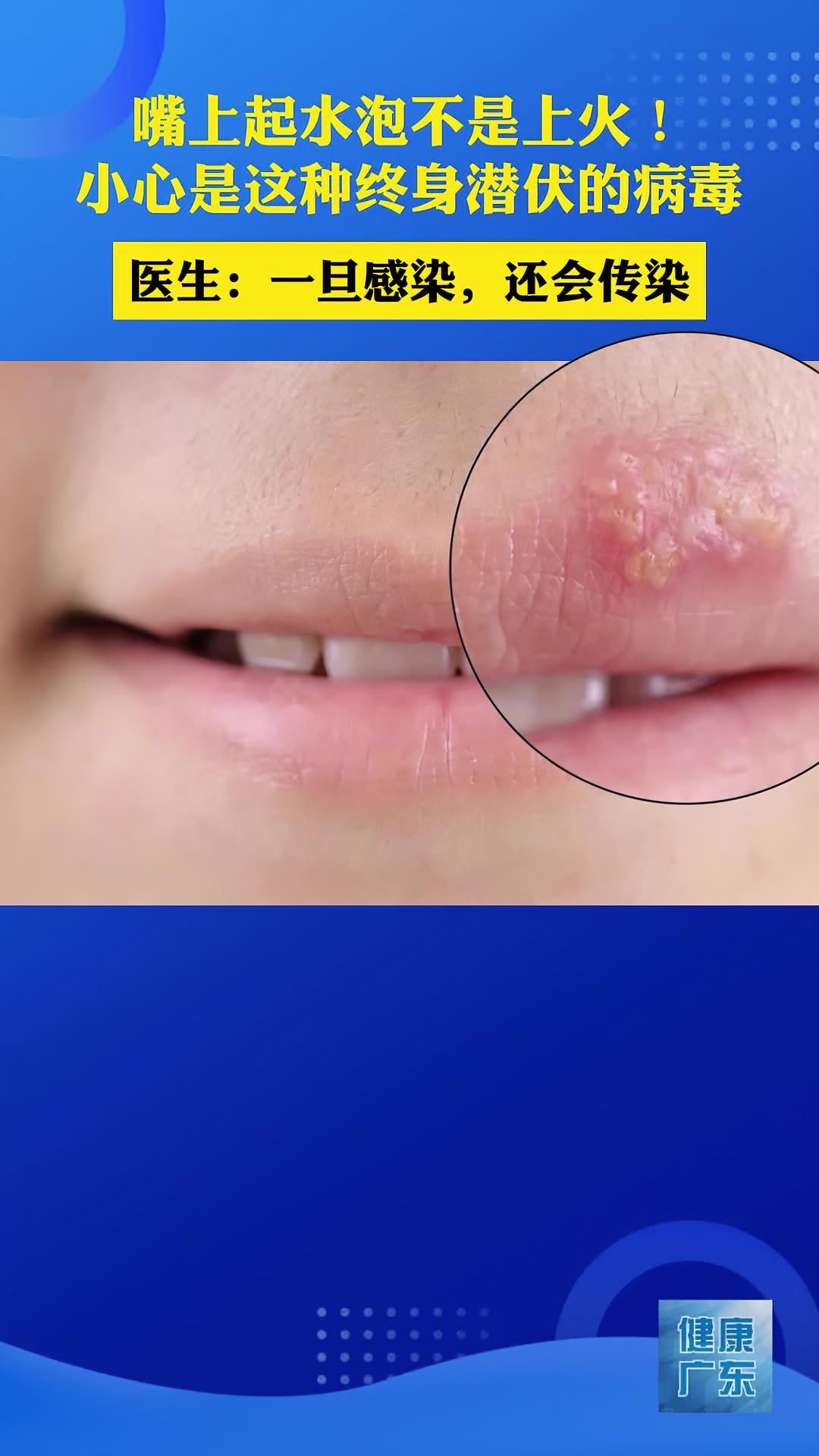 嘴唇疱疹怎么快速消除