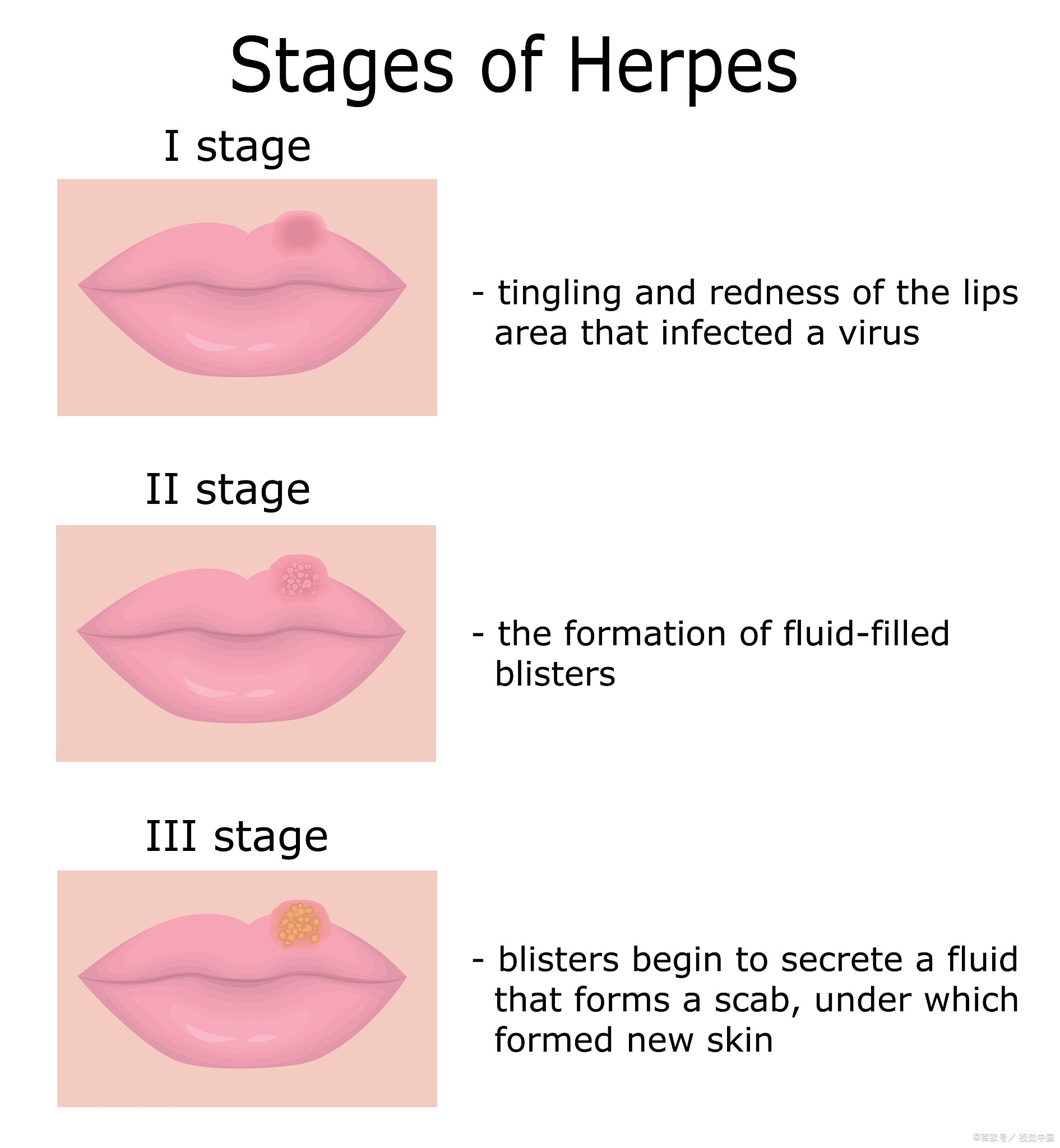嘴唇疱疹怎么快速消除