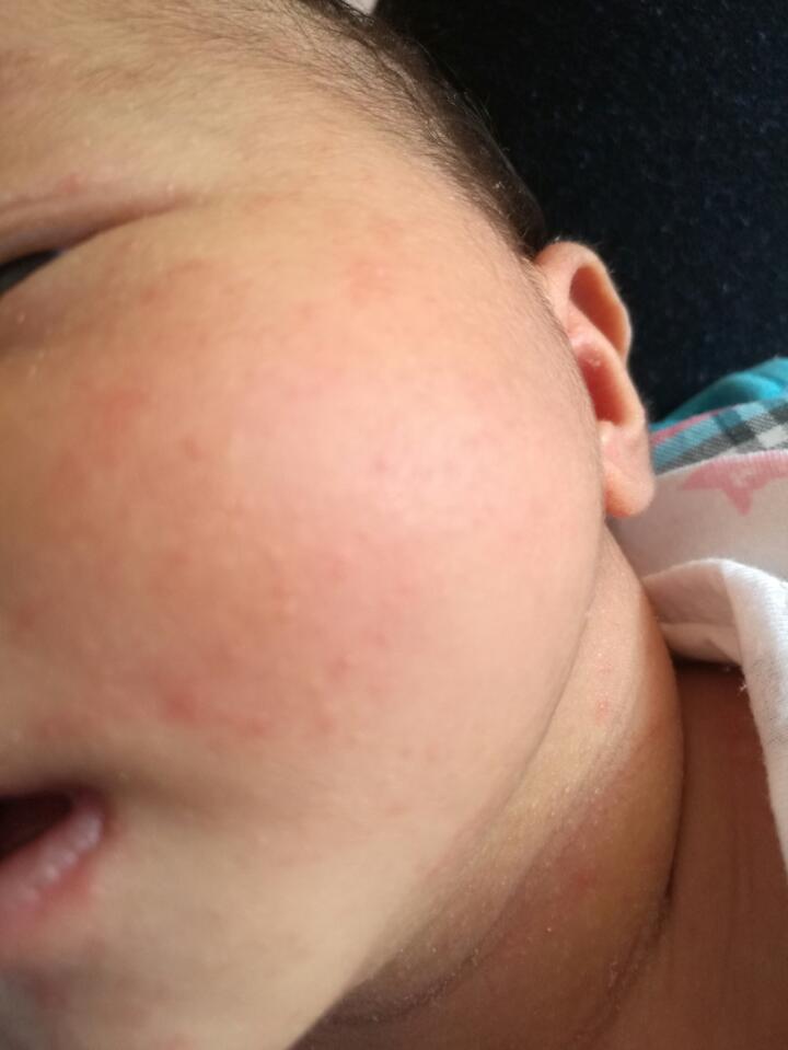 宝宝脸上有小红点