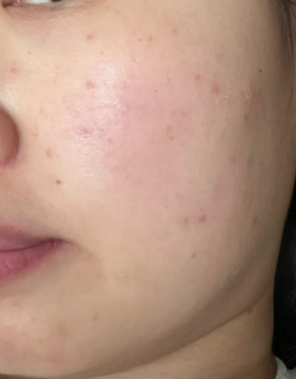 脸上长了许多红点怎么办
