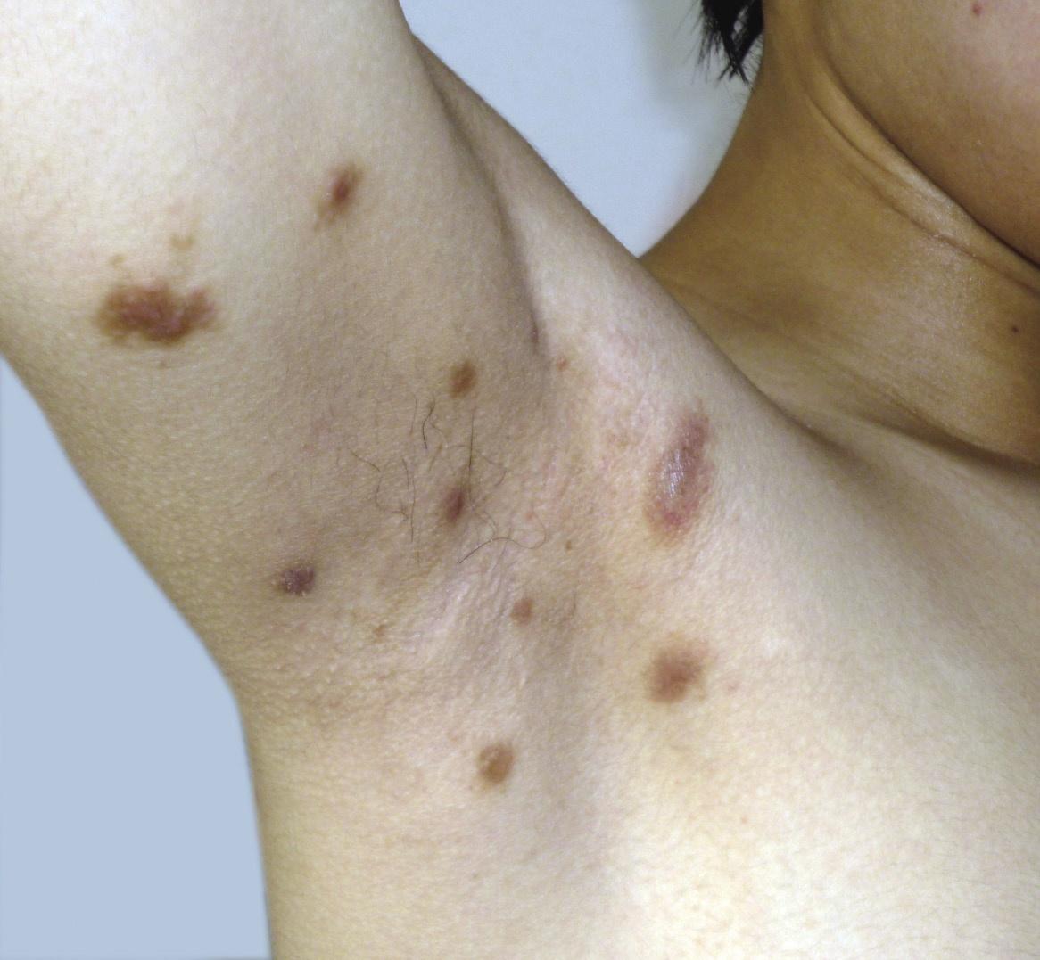 皮下结节是什么