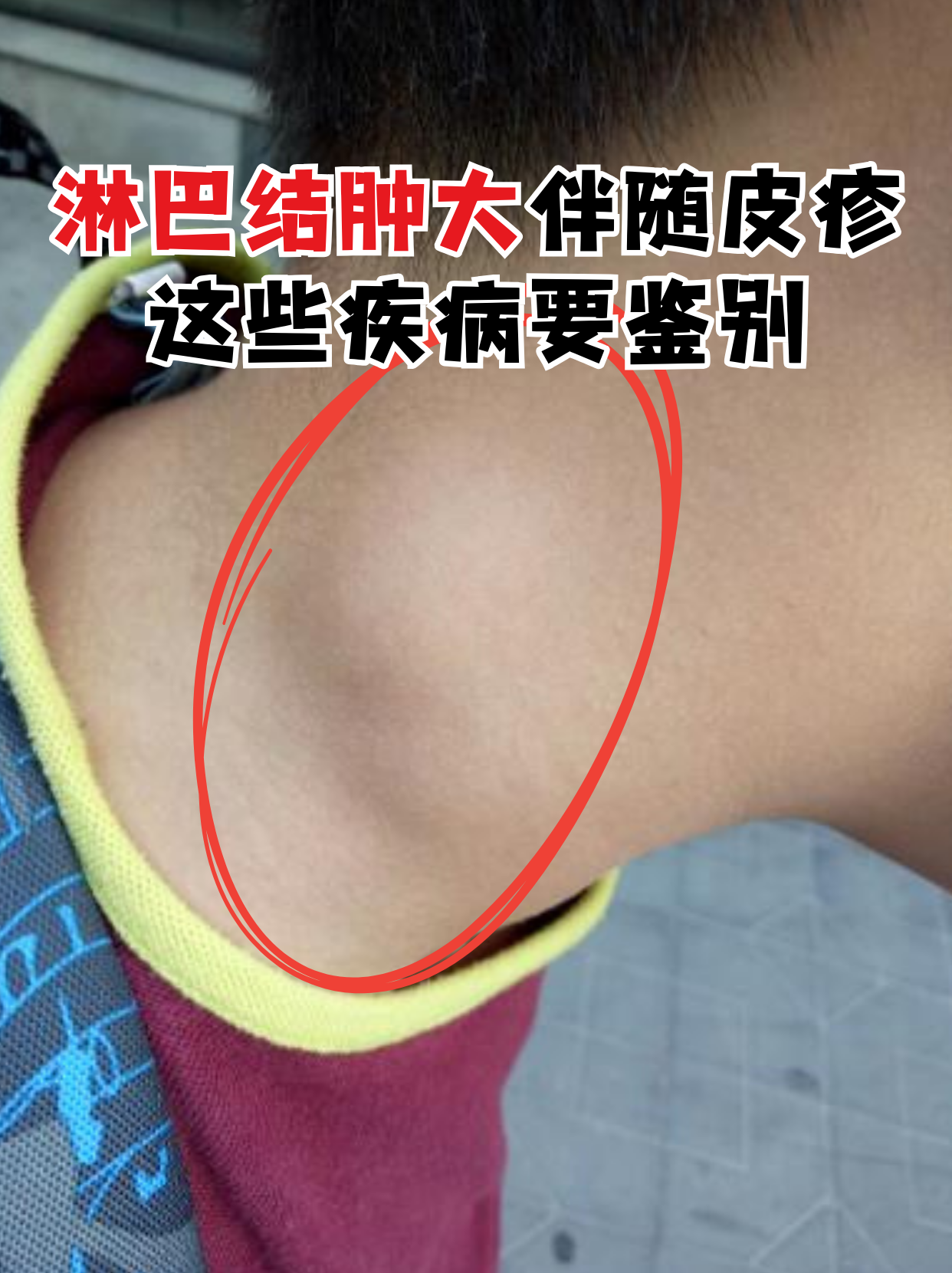 淋巴结炎要多长时间会好