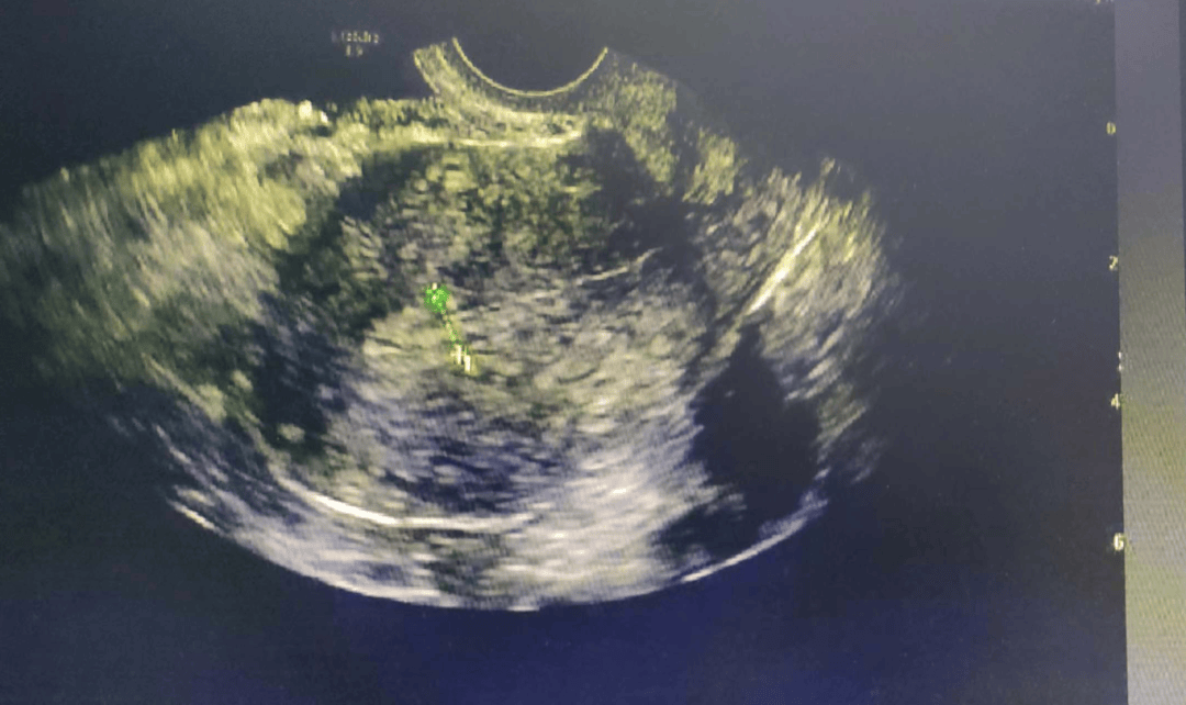 妇科彩超能查出什么