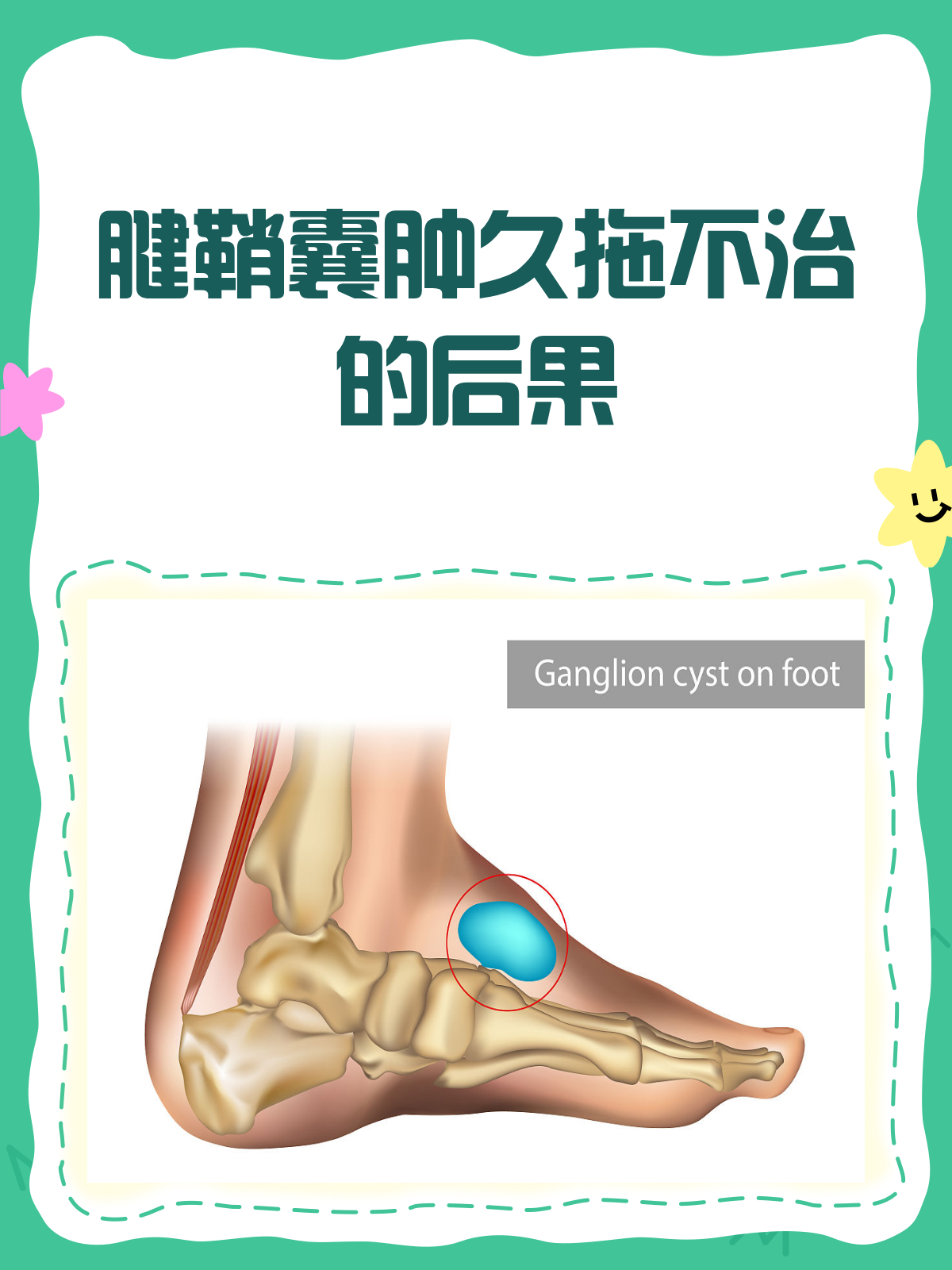 腱鞘囊肿有哪些危害?