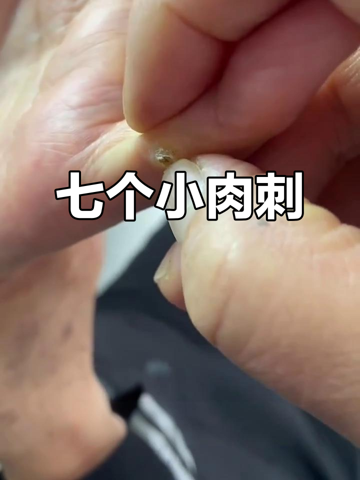 为什么手指上肉刺特别多