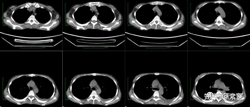 petct与增强ct的区别