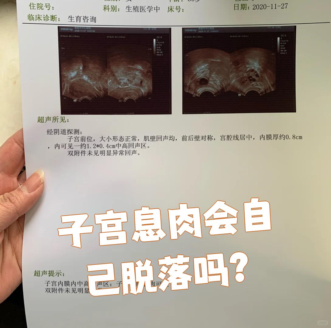 子宫息肉需要手术吗
