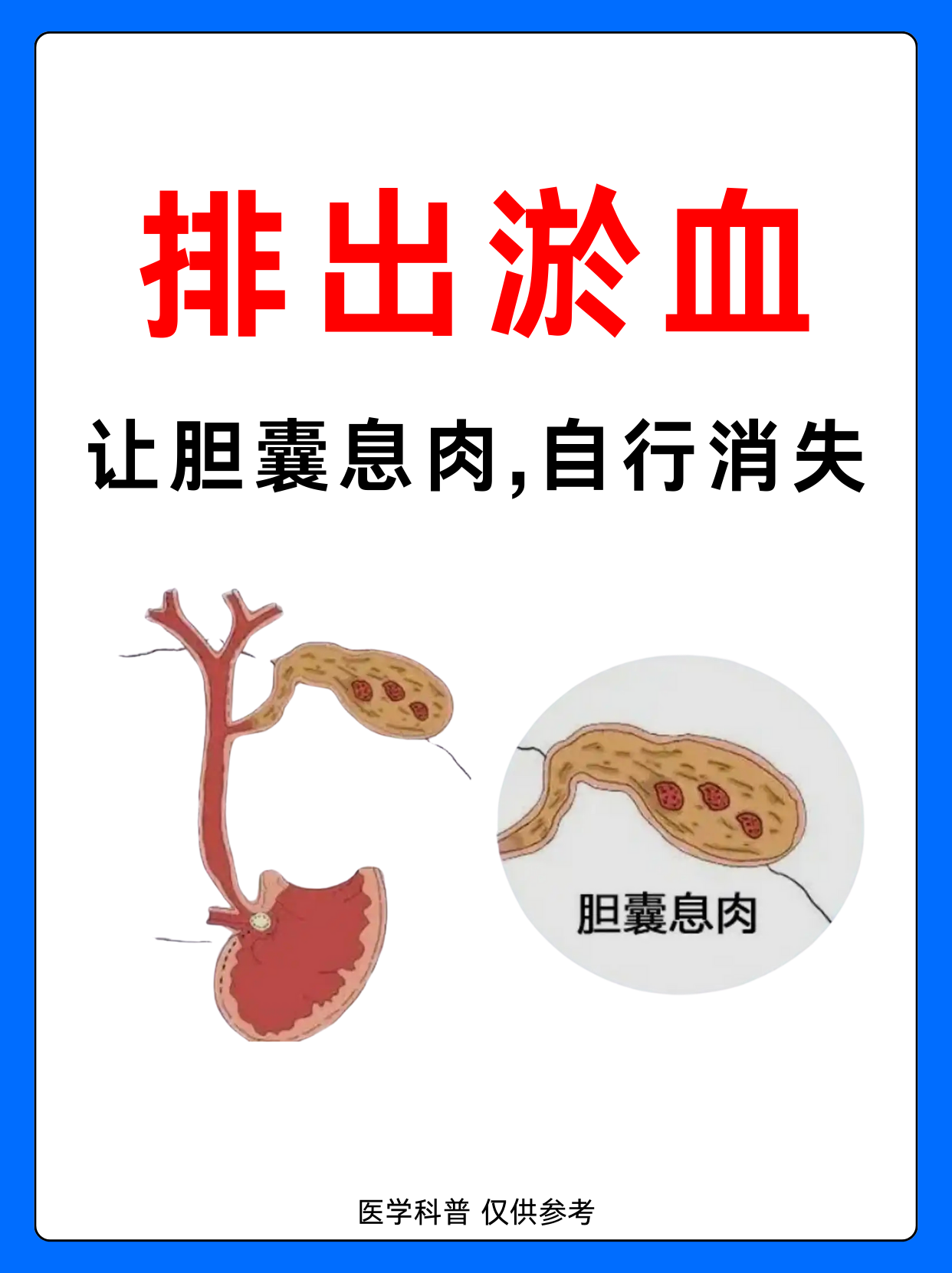 胆息肉是怎么回事