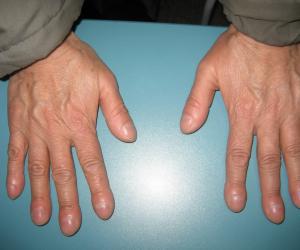 什么是未分化结缔组织病啊是怎么引起的