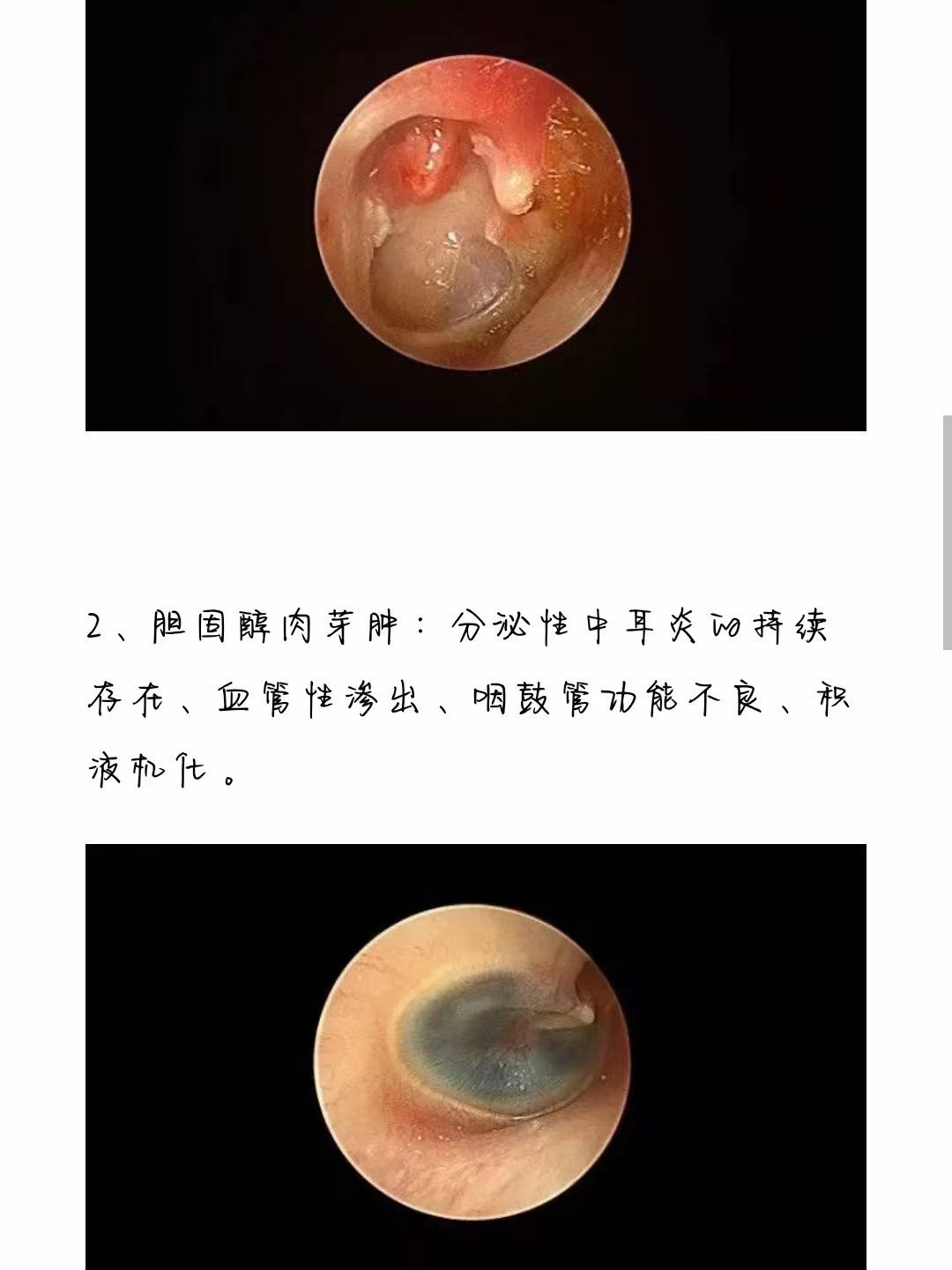 渗出性中耳炎能自愈吗