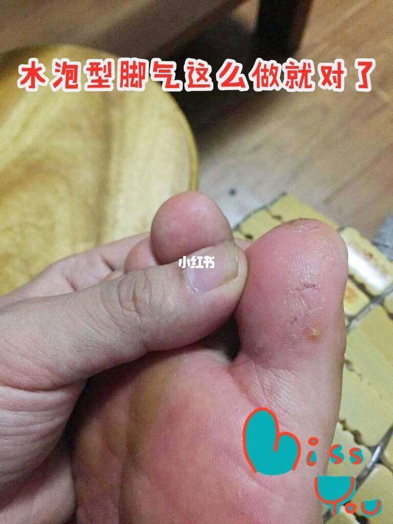 脚底长水泡怎么办