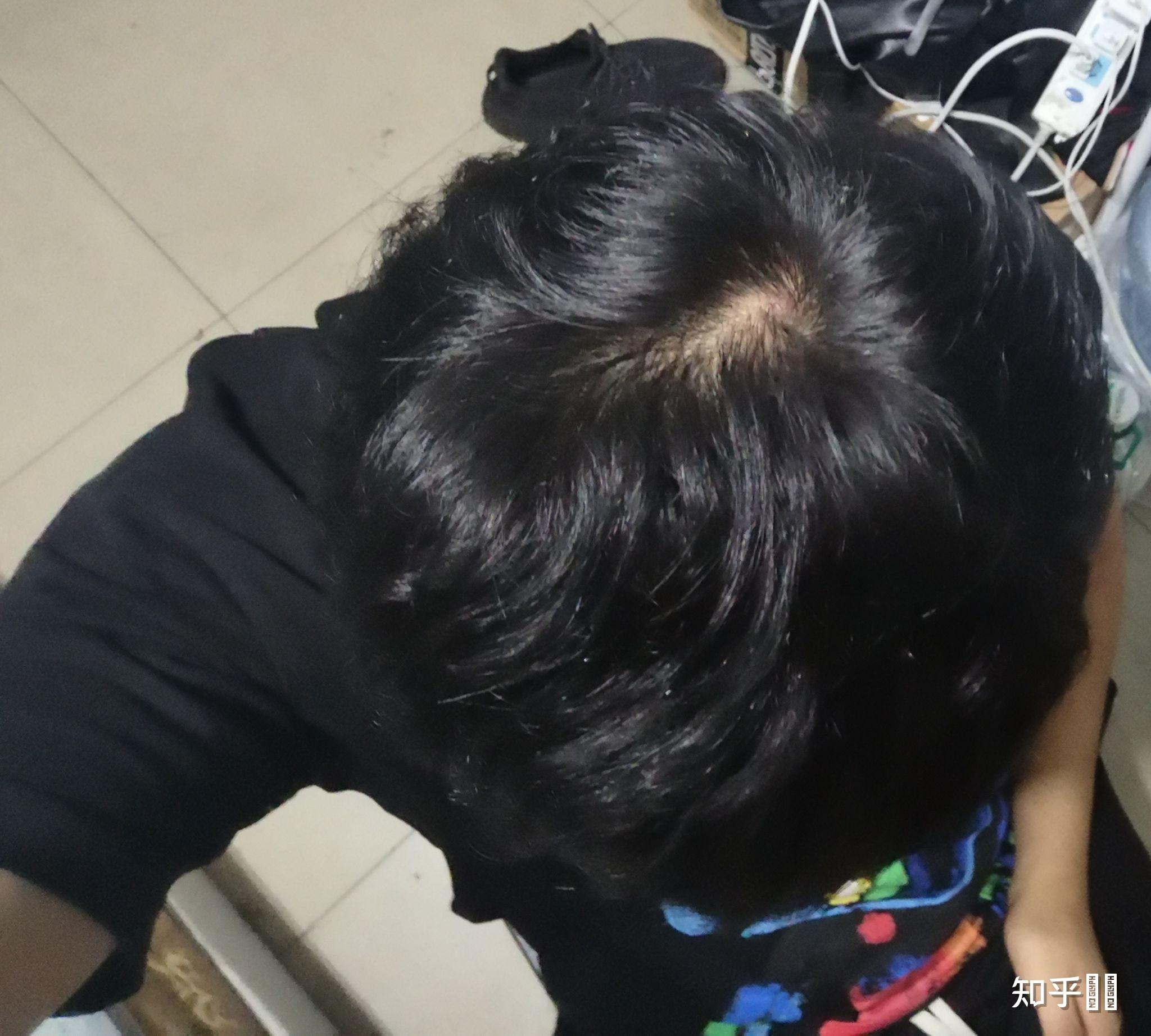 请问我这个发旋正常吗