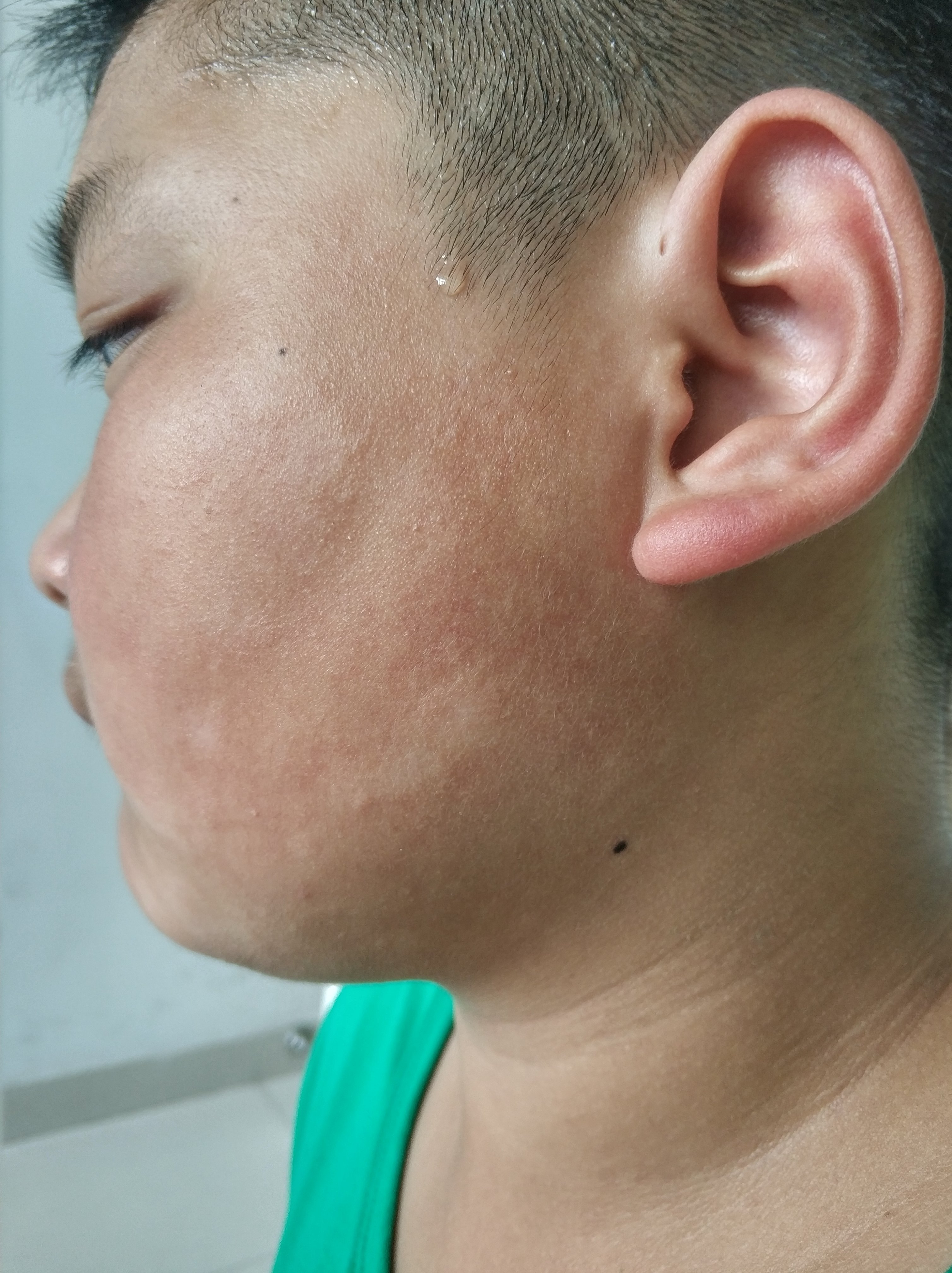 小孩脸上有淡白斑是得了什么病