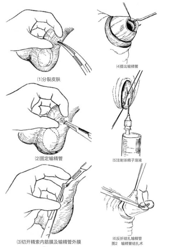 男人结扎可以恢复吗