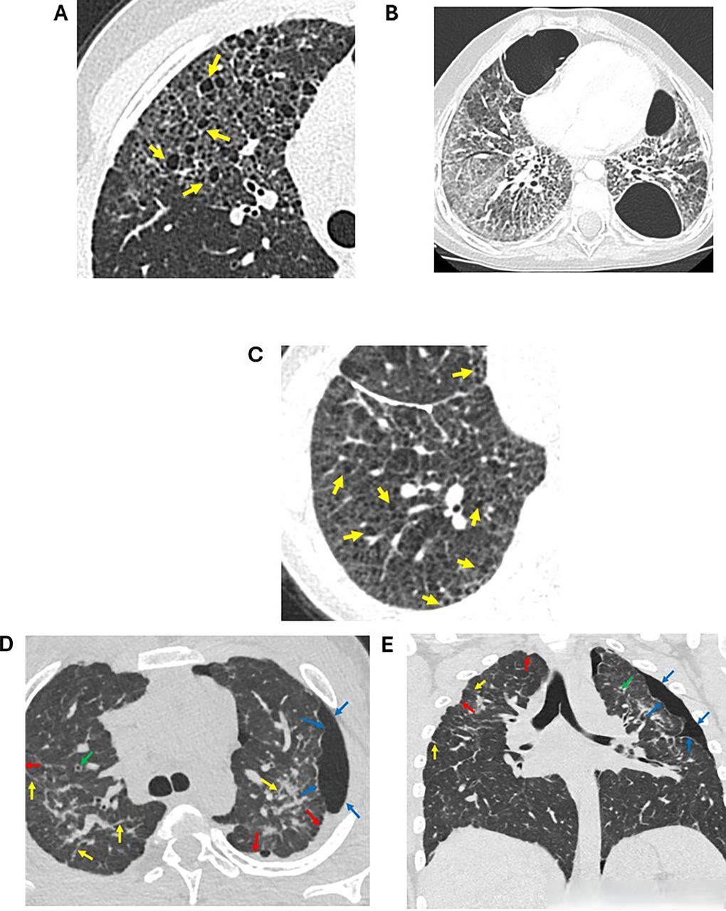 肺纤维化什么意思?