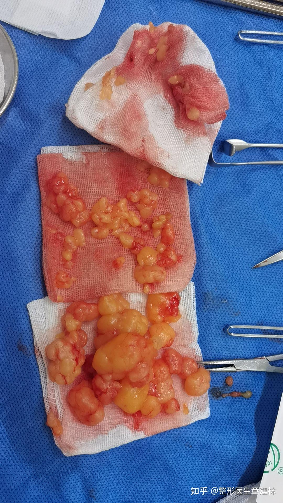 皮下脂肪瘤严重吗