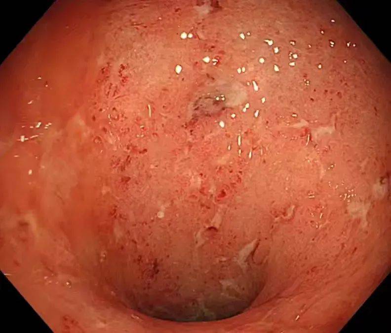 溃疡性结肠炎好了