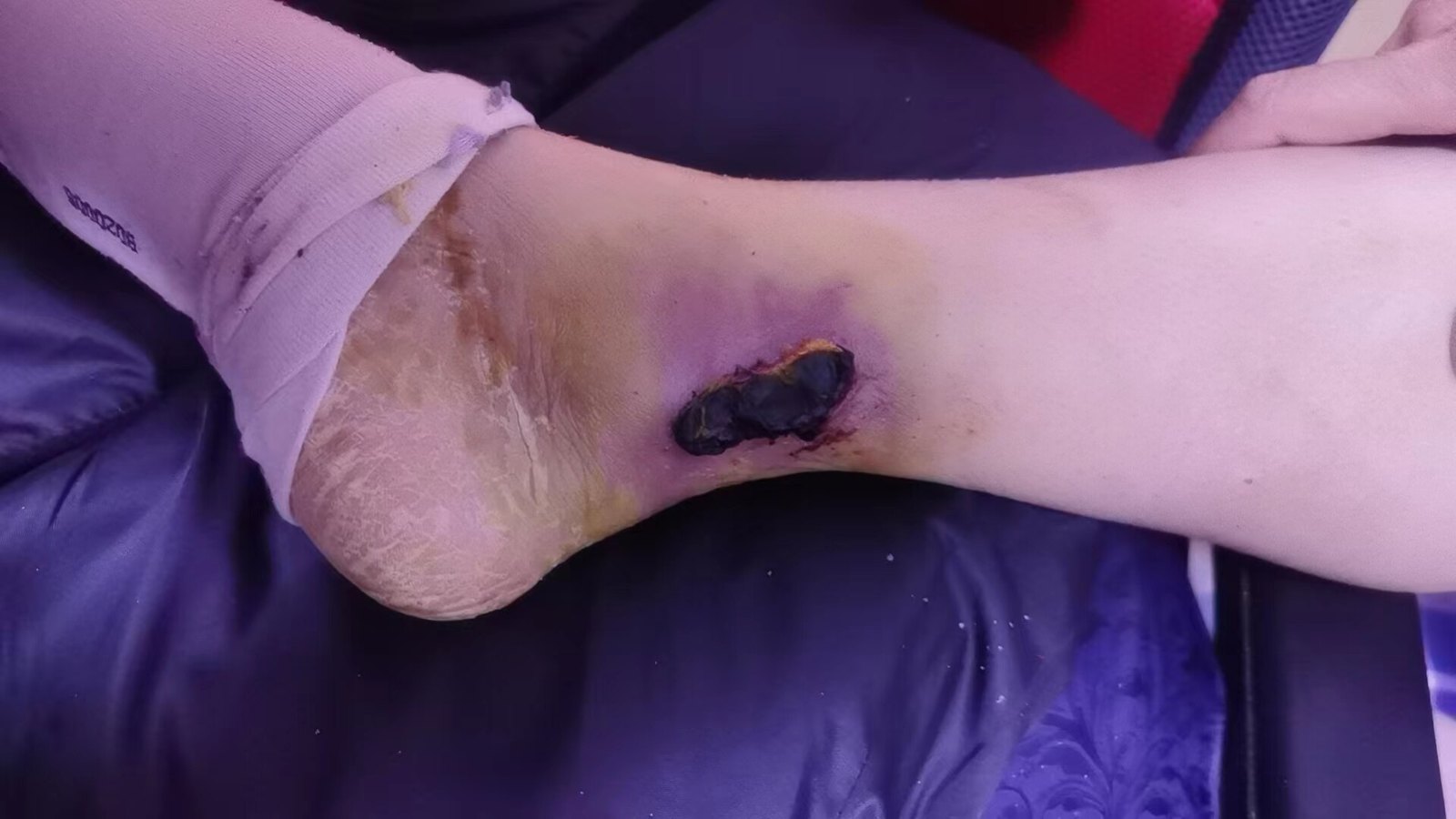 下肢溃疡如何治疗