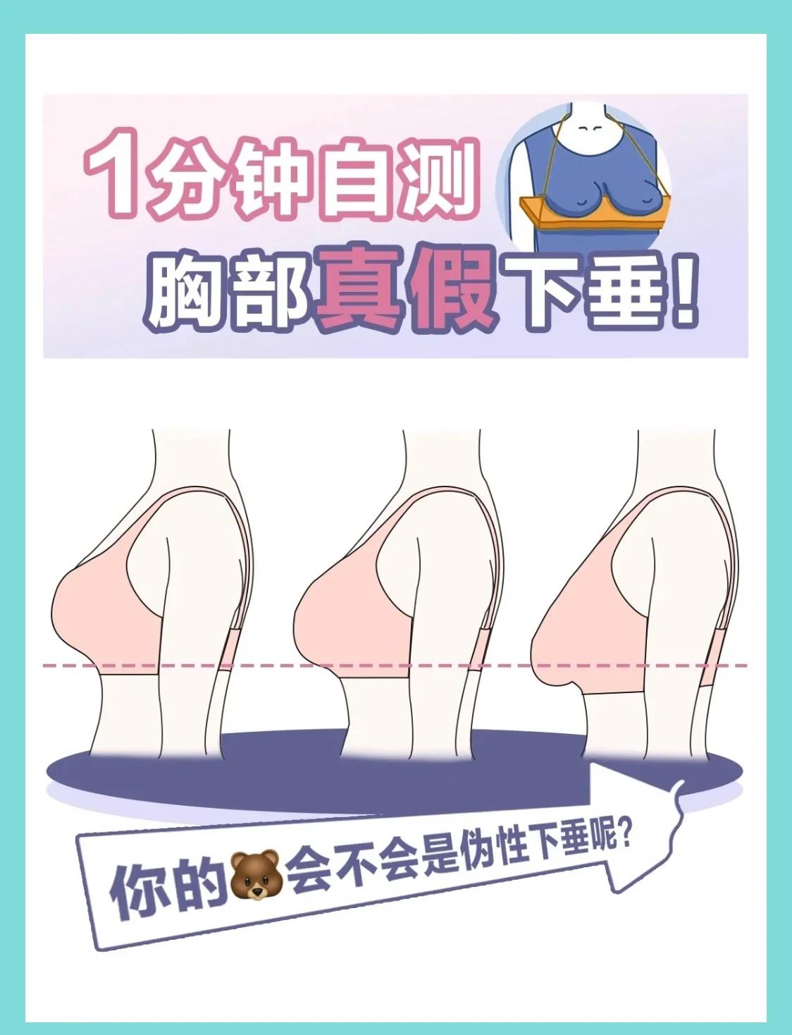 胸下垂外扩怎么办