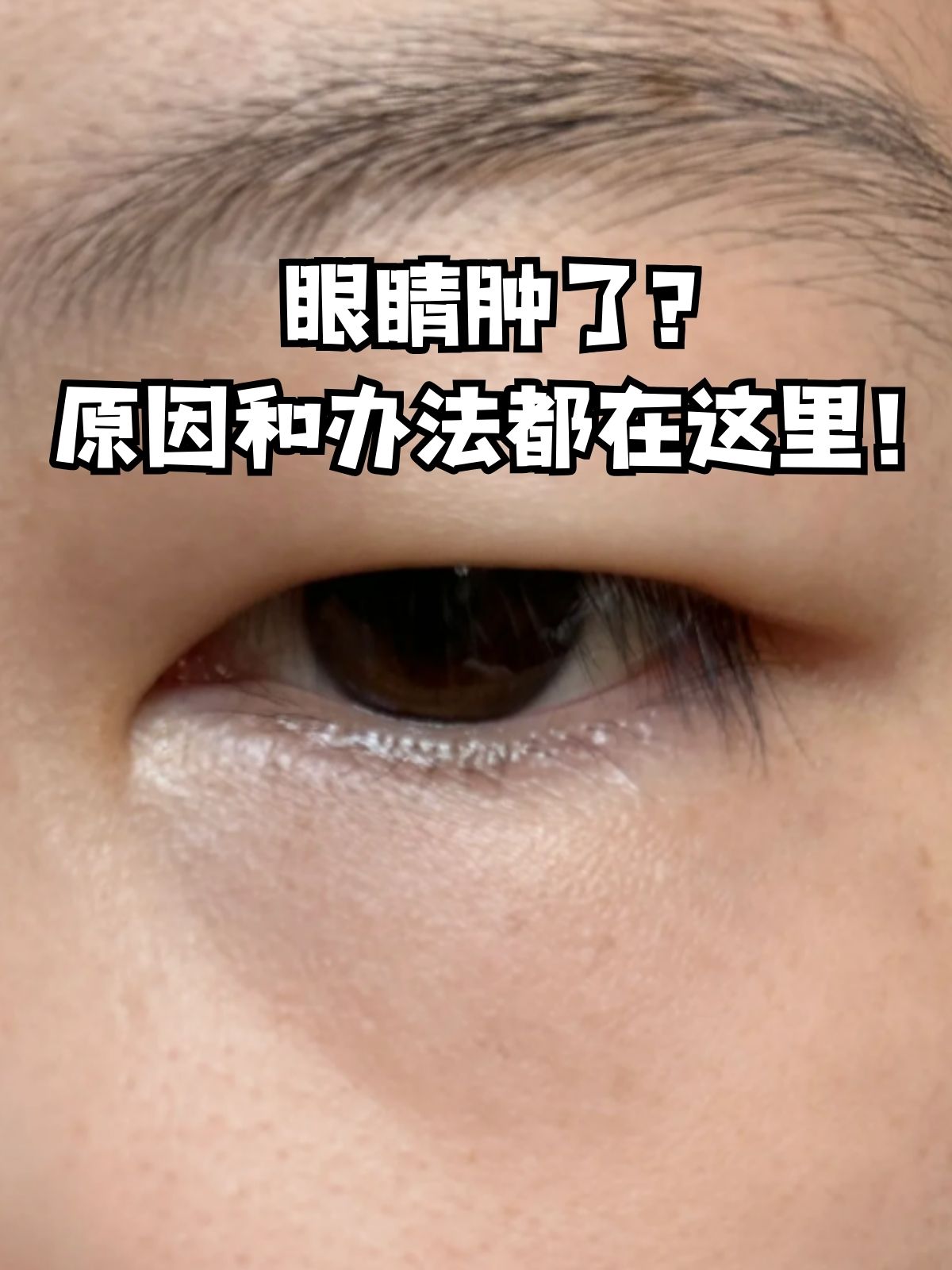 上眼皮浮肿是什么原因引起的