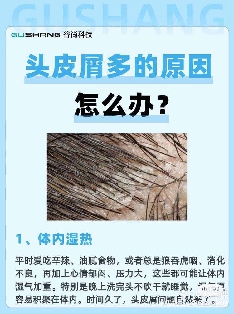 头皮屑太多,怎么办?