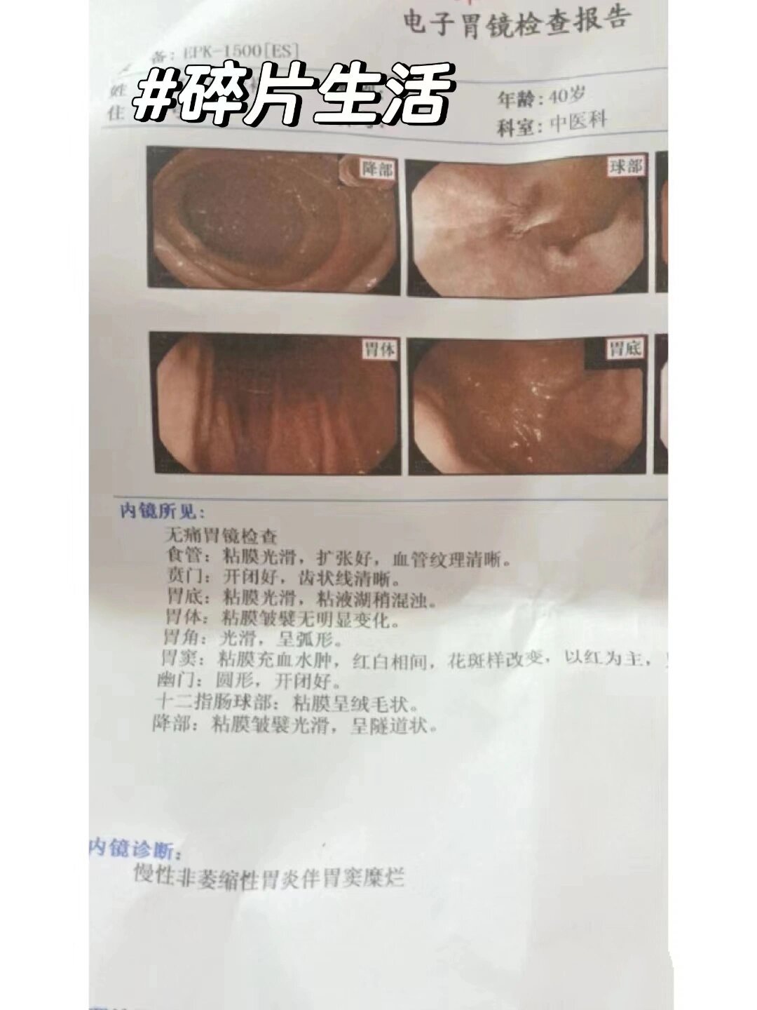 糜烂性胃炎严重吗?