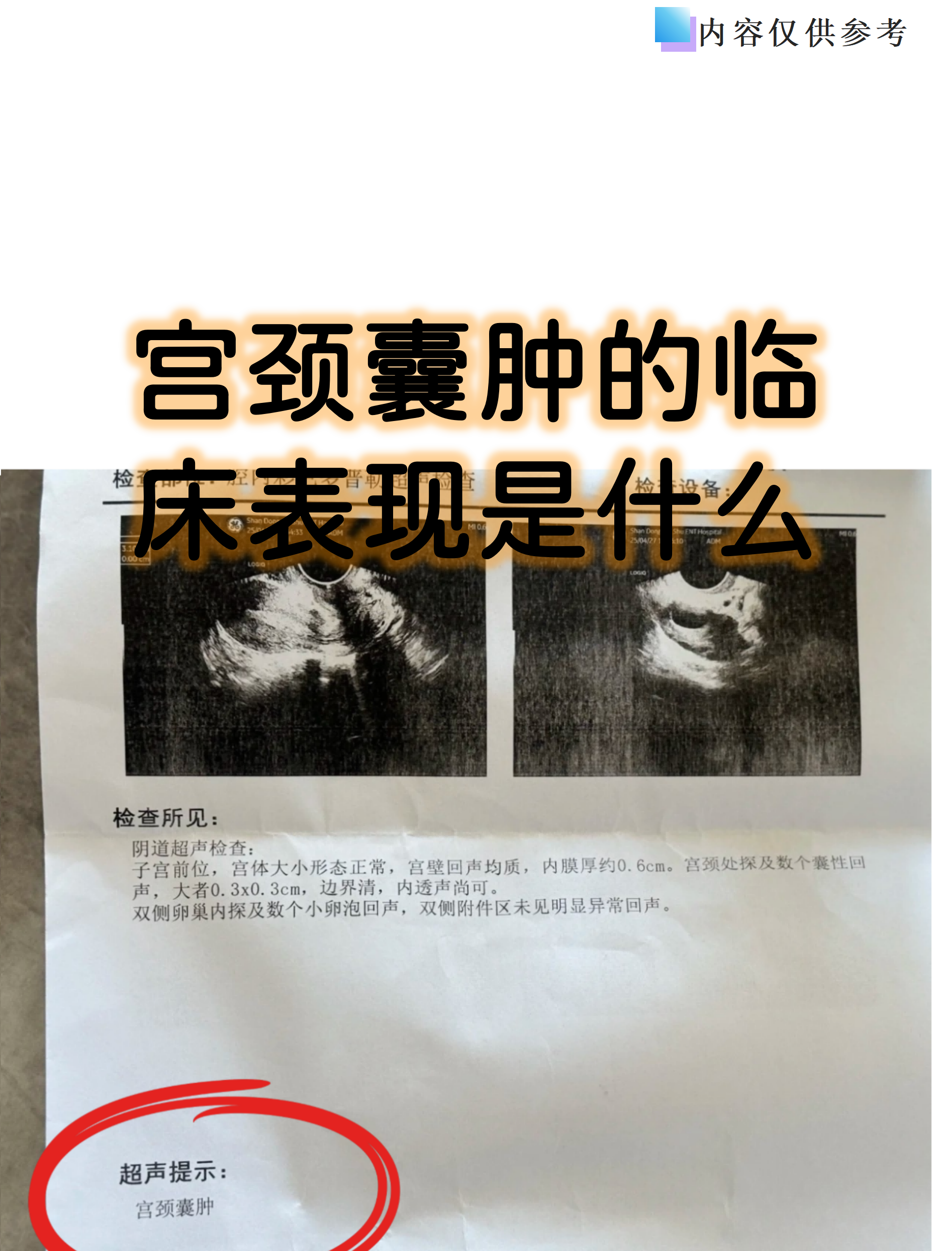 子宫囊肿有哪些症状表现?